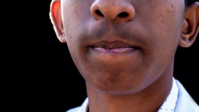 Herpès : une maladie virale et contagieuse 13 Herpès : une maladie virale et contagieuse 12