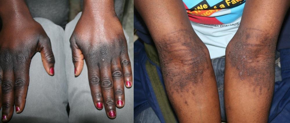 Afrique de l’ouest : Des injections blanchissantes nocives pour la santé 2 Afrique de l’ouest : Des injections blanchissantes nocives pour la santé 2