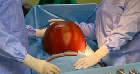 Tenkodogo : Une femme soulagée d’un kyste ovarien de 20 kg 2 Tenkodogo : Une femme soulagée d’un kyste ovarien de 20 kg 2