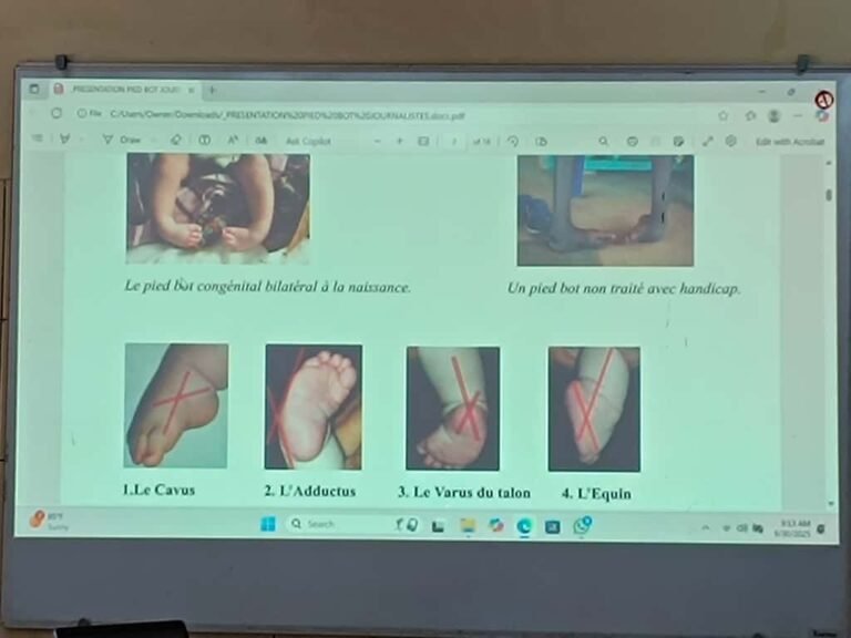 Le pied bot congénital : Une urgence sanitaire, mais négligée    1