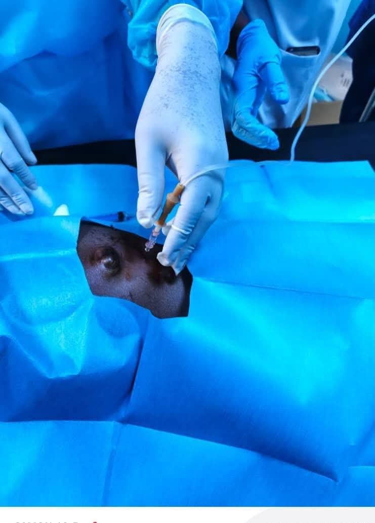 CHU de Tenkodogo : La 1re dialyse péritonéale réalisée avec succès 3