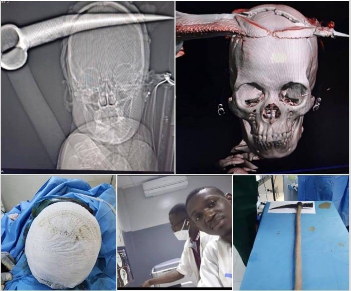 Accueil 13 Top 10 des opérations chirurgicales inédites au Burkina en 2025